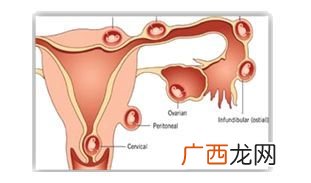 宫外孕怎么办处理方法,宫外孕必须做手术吗?