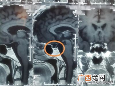 ACTH是什么,hg是什么证？