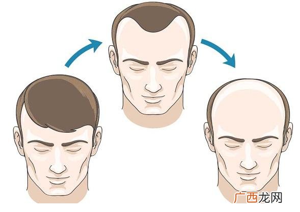秃头的原因是什么,脱发是何原因？