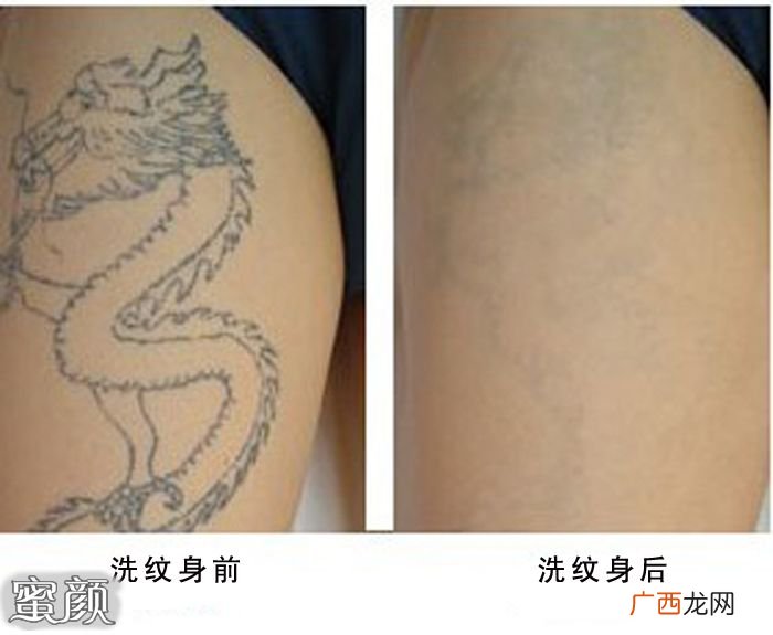 哪里有洗纹身的,洗纹身比较好的医院是哪儿？
