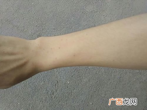 手上突然出现的小红点是什么情况,手上的皮肤里面长有小红点？