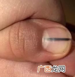 指甲上有黑线是怎么回事,指甲里有黑线怎么办？