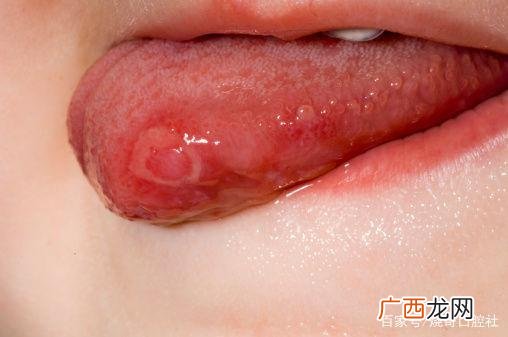 舌头上长溃疡怎么办,舌头上起口疮怎么办？