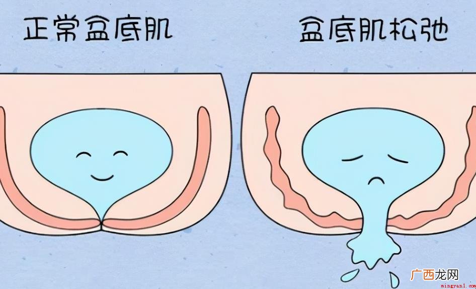 盆底肌的功效便是支撑点 什么是盆底肌