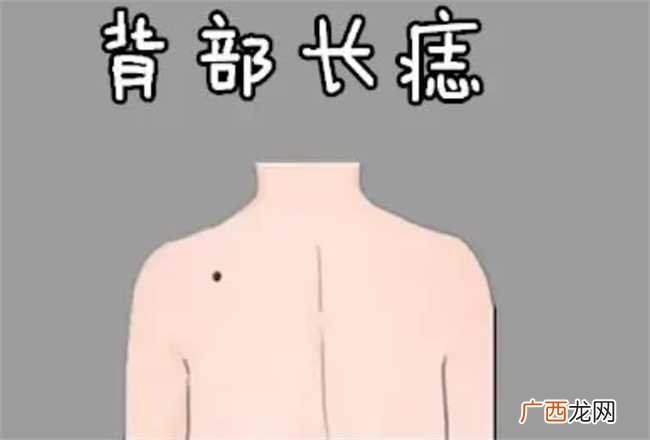 后背有黑痣好不好