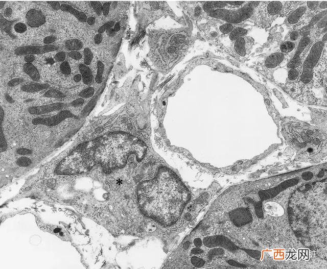 kidney是什么意思,skd与ckd的区别？