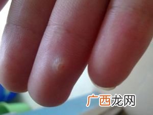 鸡眼长什么样,鸡眼刚开始是什么样的?