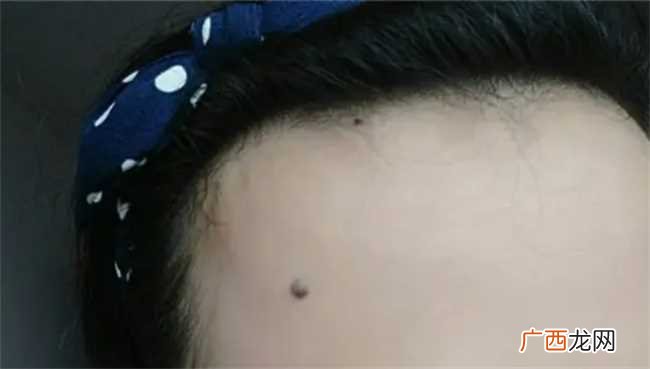 把痣去掉了影响运气吗