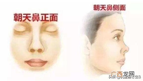 朝天鼻怎么办朝天鼻如何矫正,孩子有点朝天鼻怎么办啊？