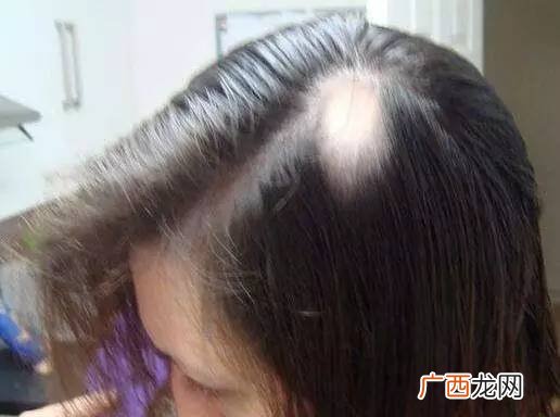 掉头发严重是什么原因女性,女人脱发严重是怎么回事？