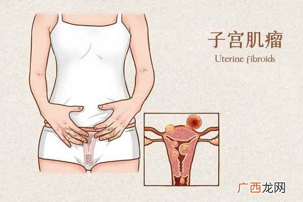 子宫肌瘤哪些食物不能吃