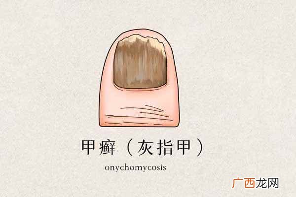 灰指甲是什么病