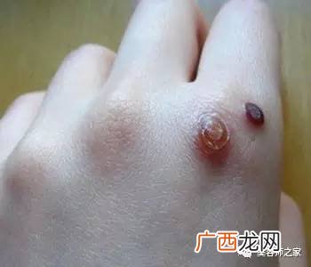 瘊子是什么,瘊子是什么样子的？
