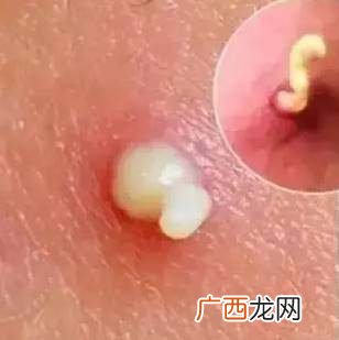 什么是白头粉刺,闭口和白头的区别？