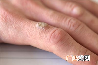 母瘊子与公瘊子的区别,公猴子有蛋吗？