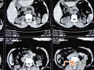 左肾疼怎么办,我的左肾脏部位这几天一直隐隐作痛，请问怎么回事？