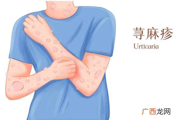 海鲜过敏症状