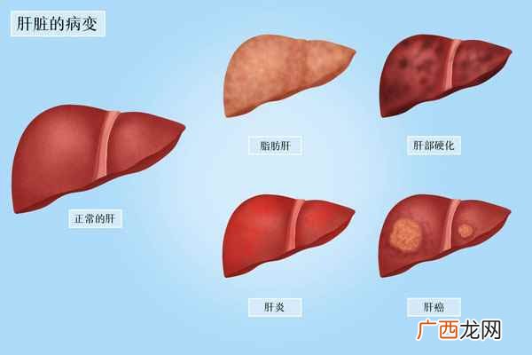 脂肪肝吃什么好