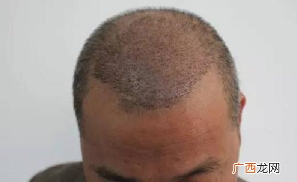 植发有什么后遗症,植发的危害是什么？