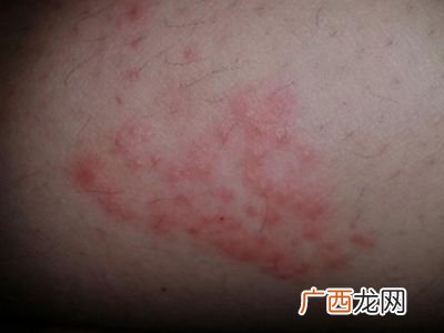 皮肤过敏是什么原因引起,刚刚7个月的宝宝，怎么会皮肤过敏?该怎么办？
