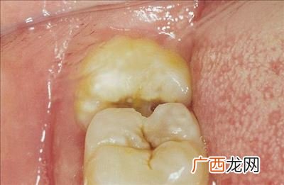 智齿有什么用,大牙没了可以用智齿代替大牙吗？