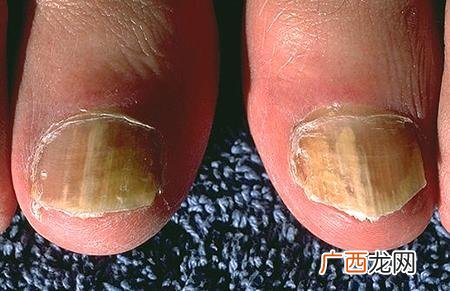 什么是甲沟炎,甲沟炎是怎么回事如何治疗？