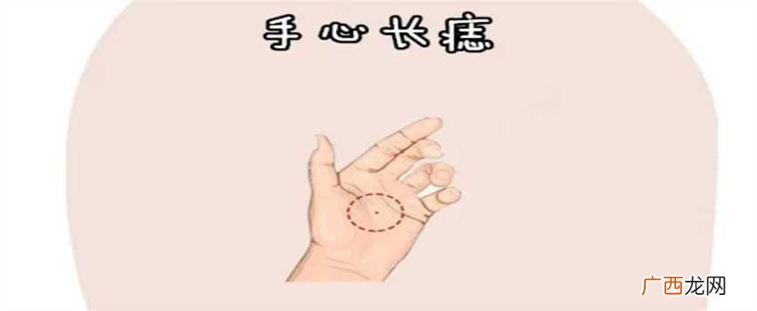 大多是好的，寓意各不同 手掌有痣好不好？代表什么寓意