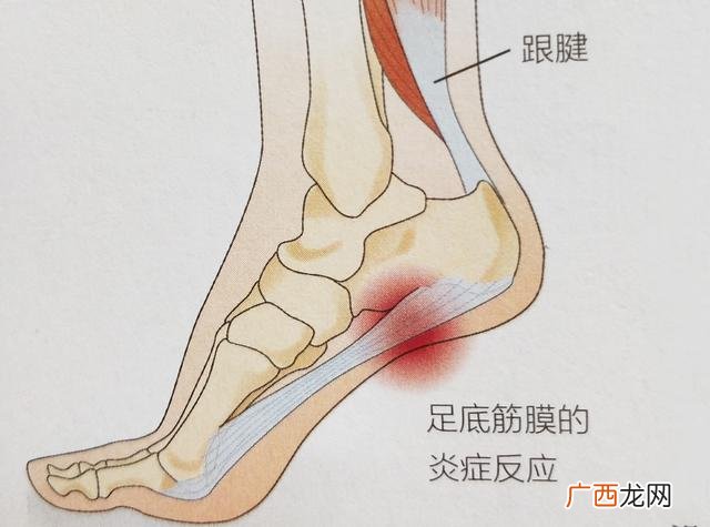 肌腱炎是什么症状,腱鞘炎症状有哪些？