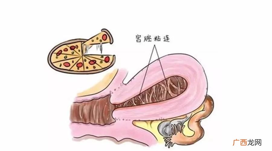 宫腔粘连的症状有哪些,宫颈粘连有什么症状？
