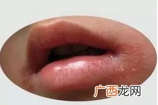 长疱疹是什么原因,疱疹病毒感染是怎么引起的?