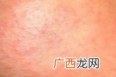 皮肤过敏不能吃什么,孩子嘴边过敏怎么办?