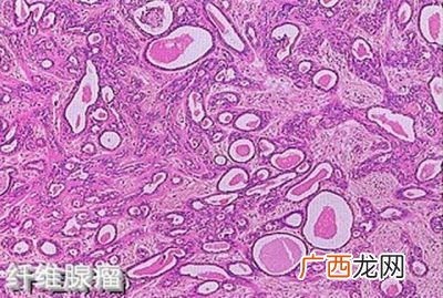 乳腺结节是怎么回事,造成乳腺结节的原因有什么，预防措施有哪些？