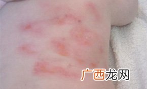 什么治湿疹最有效,治疗湿疹的最好方法？