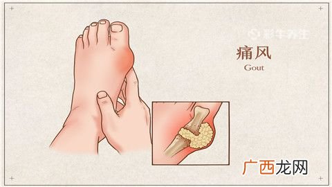 痛风怎么消肿最快,痛风消肿的最快方法是什么？