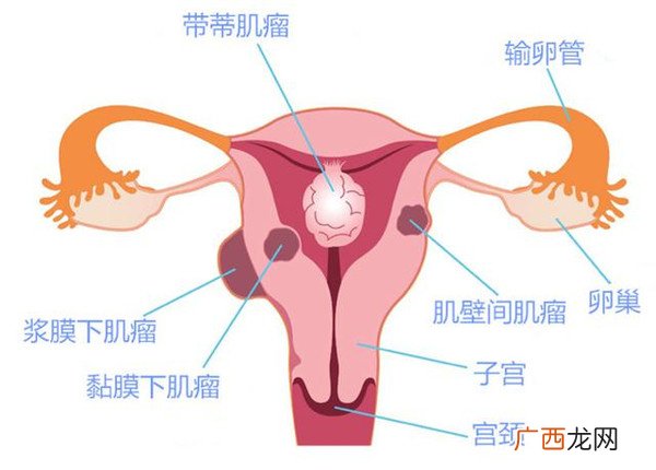 为什么会得子宫肌瘤,有子宫肌瘤为什么月经会多？
