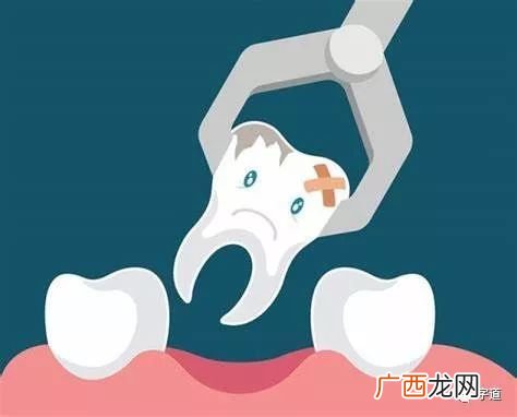 拔牙后吃什么消炎药,拔牙后吃什么消炎药最好？