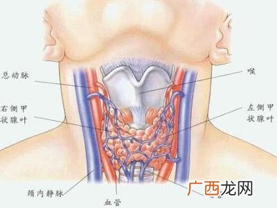甲状腺结节有什么症状,甲状腺结节的症状有哪些?
