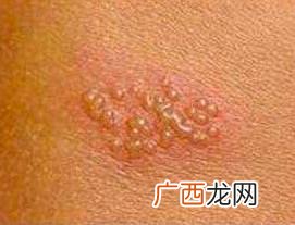 疱疹是什么原因引起的,疱疹怎么引起的？