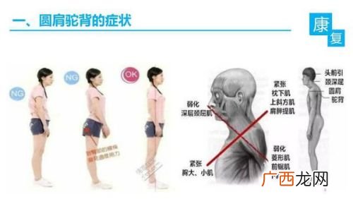 圆肩怎么矫正,自己的肩膀有点溜肩，怎么锻炼可以成平肩。或者说模特的平肩是如何练成的？谢谢知情者？
