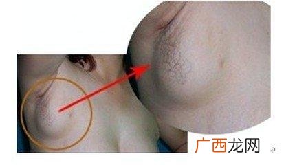 腋下副乳怎么消除,腋下副乳怎么可以消除？