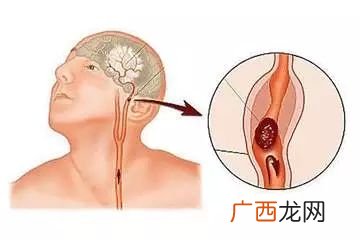 血栓是怎么形成的,血栓的形成是怎样的?