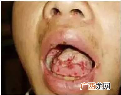 口腔溃疡是上火吗,本人长期口腔溃疡,会不会是上火引起的?
