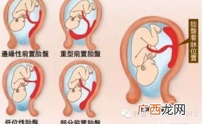 胎盘后壁是什么意思,请问胎盘位于子宫后壁是什么意思？