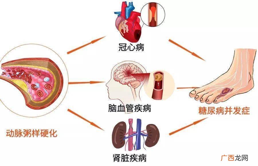 血糖高有什么症状,血糖高有什么症状吗?