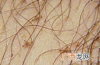 阴虱是怎么回事,阴虱是怎么回事什么原因长的？