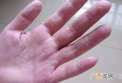 手脚脱皮是什么原因,手脚脱皮怎么回事？