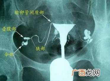 做输卵管造影痛吗,子宫输卵管造影痛不痛是怎么回事?