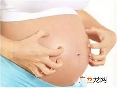 孕妇肚皮痒是怎么回事,孕妇身上很痒是怎么回事？