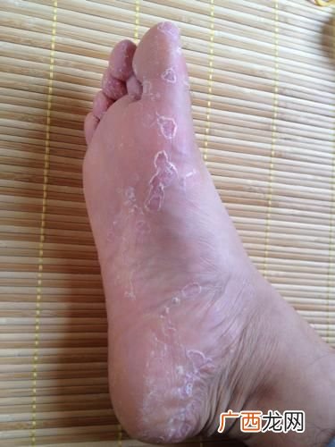 脚掌脱皮是什么原因,请问一下脚掌脱皮常年，是什么引起的？
