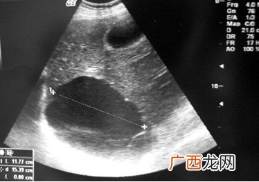 b超和彩超一样吗,彩超是超声波吗？